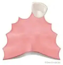 1-2 Tooth Replacement Acrylic Partial - Dentist Directed  - Impression Kit Included - Image 10