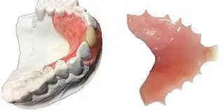 1-2 Tooth Replacement Acrylic Partial - Dentist Directed  - Impression Kit Included - Image 12