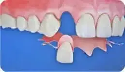 1-2 Tooth Replacement Acrylic Partial - Dentist Directed  - Impression Kit Included - Image 5