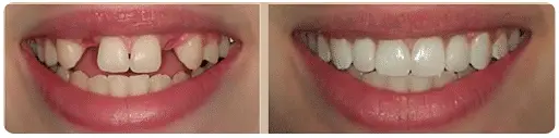 1-2 Tooth Replacement Acrylic Partial - Dentist Directed  - Impression Kit Included - Image 6
