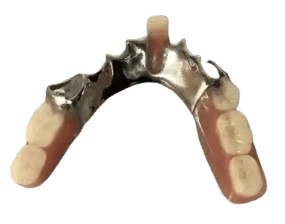 Metal Partial Dentures - Dentist Directed  - Impression Kit Included - Image 5