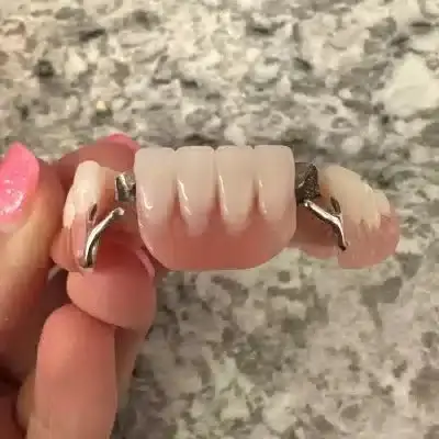 Metal Partial Dentures - Dentist Directed  - Impression Kit Included - Image 8