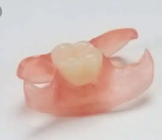 Unilateral Partial 1-3 Teeth - Dentist Directed  - Impression Kit Included - Image 7
